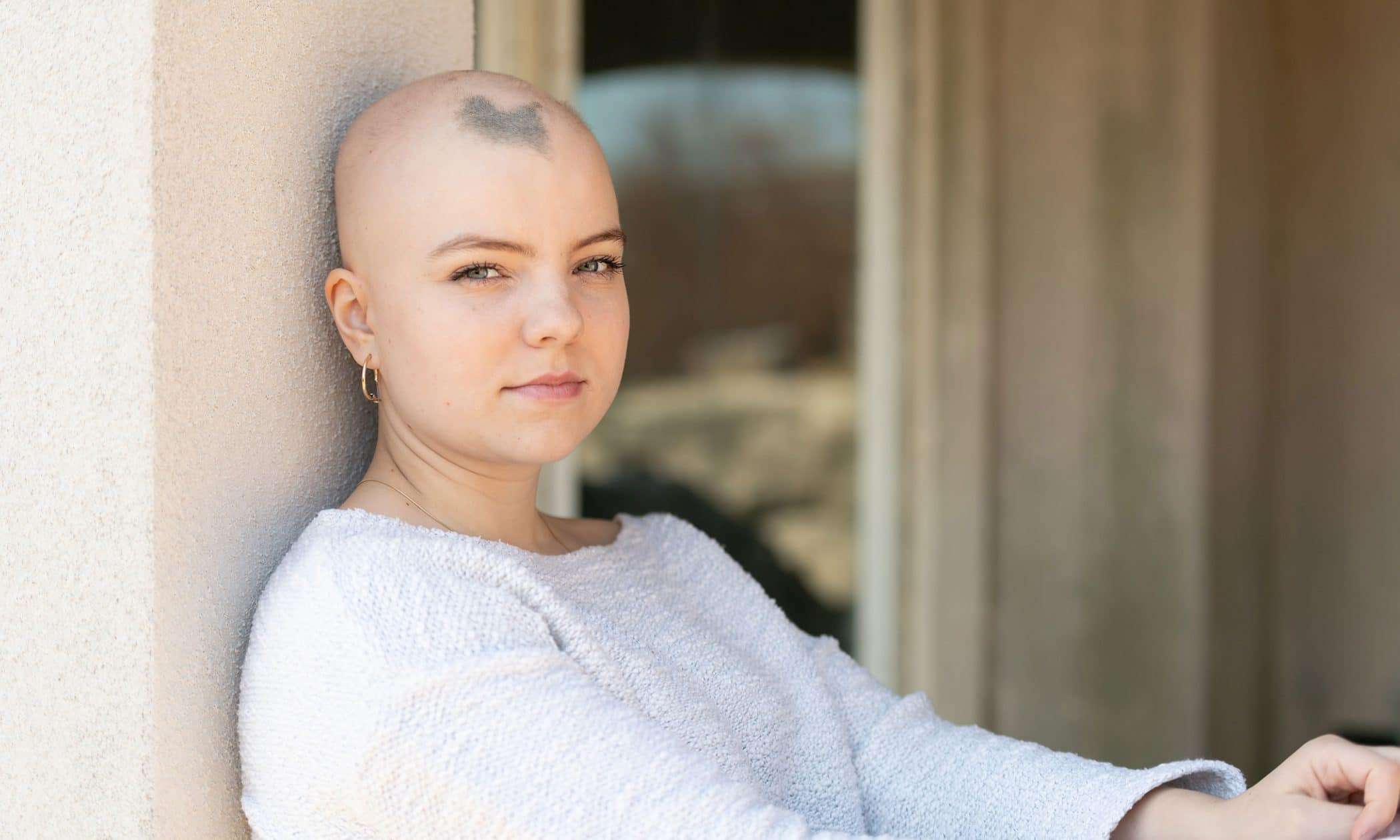 alopecia-large-3