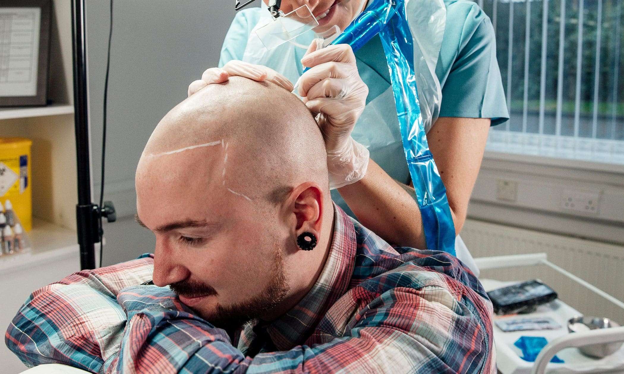 Scalp micropigmentation in action