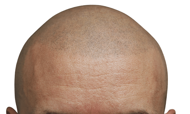 scalp micropigmentation