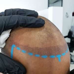 Hairline restoration with scalp micropigmentation