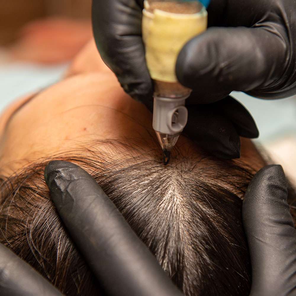 woman having scalp micropigmentation in atlanta