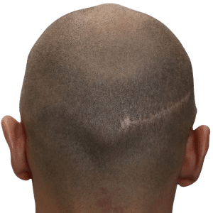 FUT scalp scar