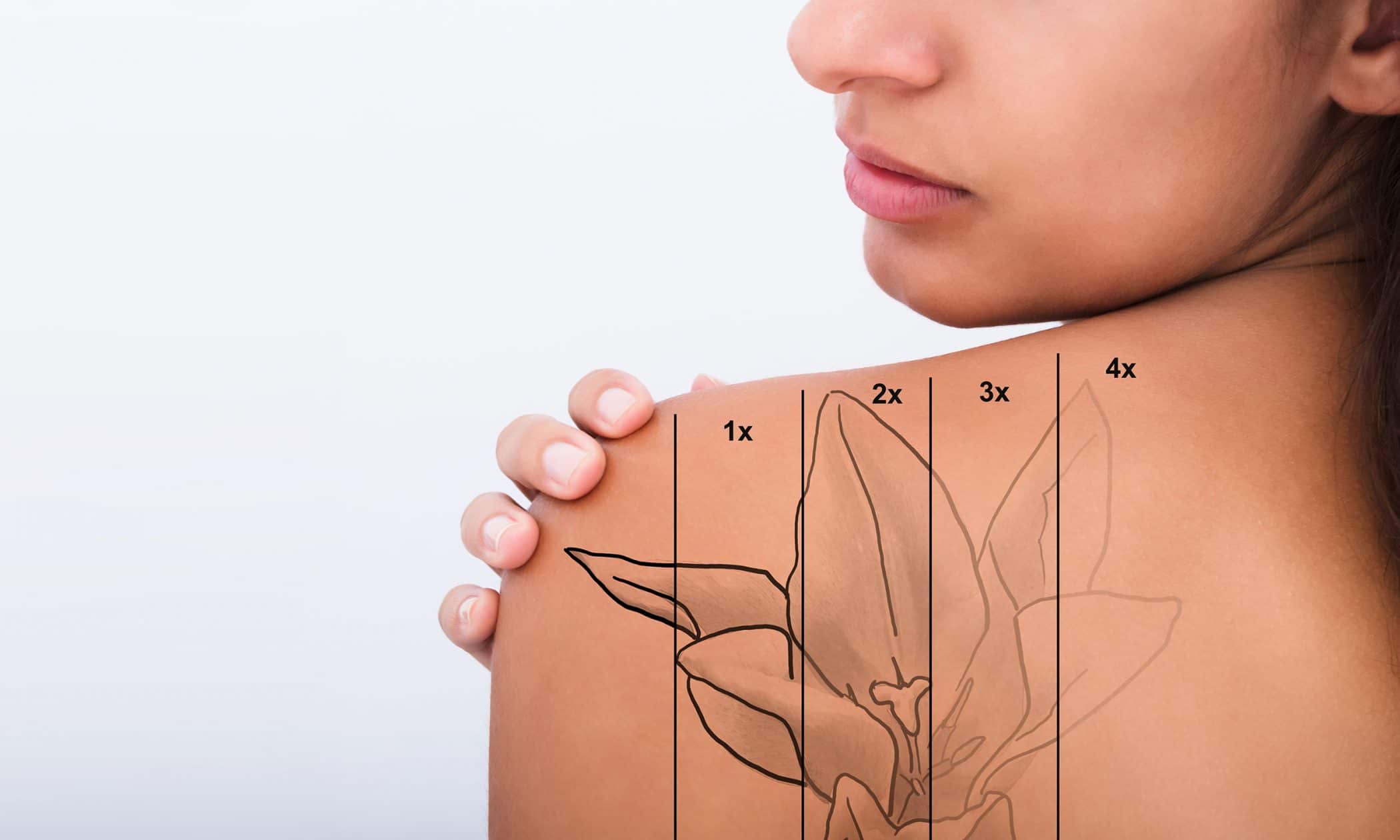 tattoo removal ga