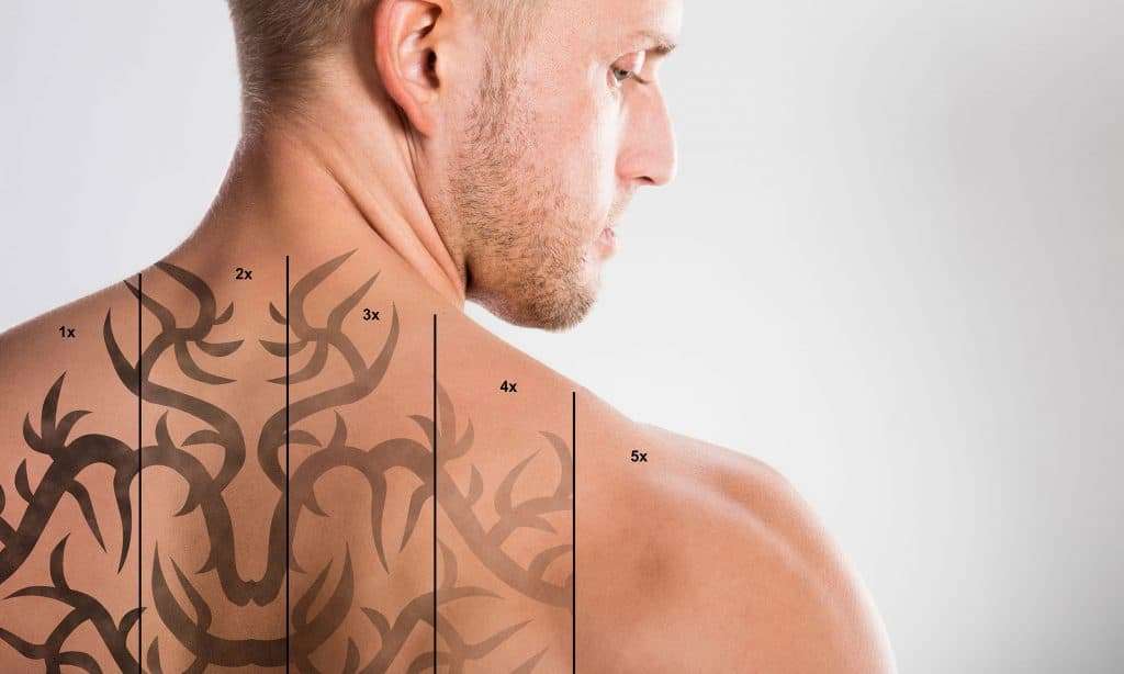 tattoo removal in atlanta
