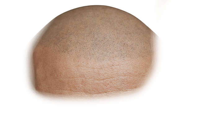 Scalp micropigmentation hairline atlanta