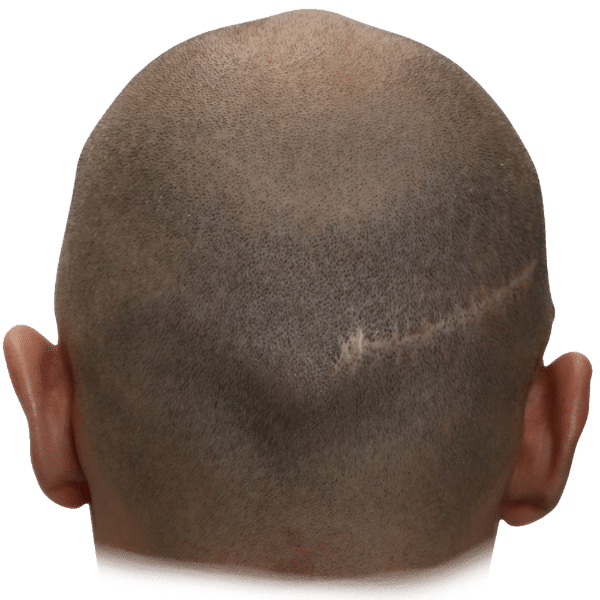 FUT scarring on scalp atlanta